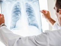 Campanie pentru combaterea stigmatizării în cazul cancerului pulmonar