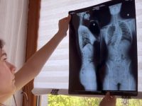 „Vreau doar să nu mă mai doară”. Diana are 12 ani și luptă cu o deformare severă a coloanei vertebrale